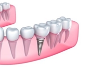 Implante Dentário no Aricanduva