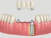 Proteses Dentária Fixa no Aricanduva