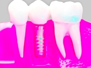 Prótese Dentária na Aricanduva