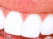 Clareamento Dentário