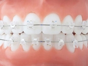 Aparelho Dentário de Porcelana