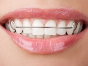 Aparelho Dentário Móvel em Itaquera