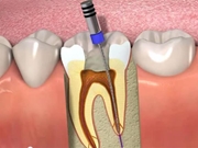 Endodontia na Mateo Bei
