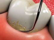 Raspagem Dentária na Zona Leste