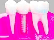 Prótese Dentária na ZL