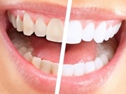 Restauração Estética Dental