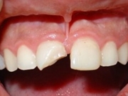 Tratar Dente Quebrado na Z Leste