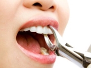 Extração Dentária no Utinga