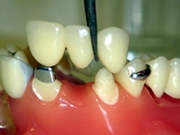 Colocar Pivô Dentário na Região de São Mateus