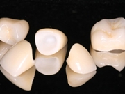 Tratamento com Coroa Dentária no Sesc Itaquera
